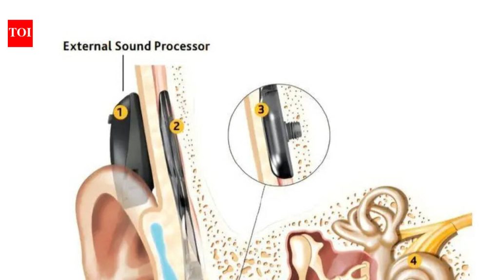 अभिनव कानाची शस्त्रक्रिया 23 वर्षांच्या वृद्धाला एकतर्फी बहिरेपणापासून बरे होण्यास मदत करते